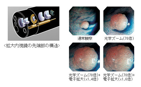 拡大内視鏡 差し替え画像
